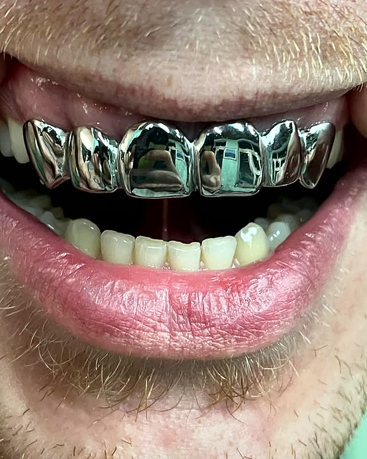 Custom silver grillz set shown on a smile